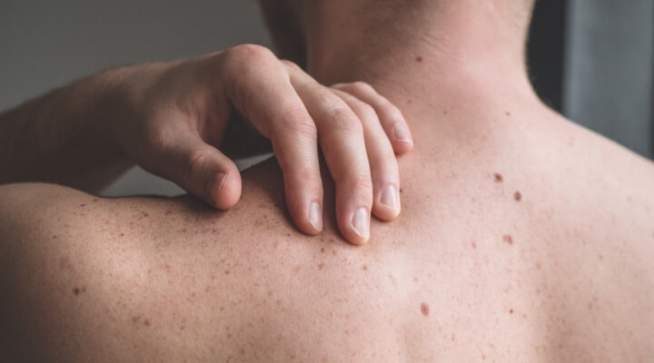 man touching moles on back