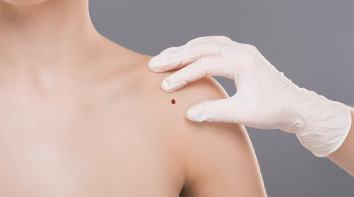 dermatologist inspecting mole