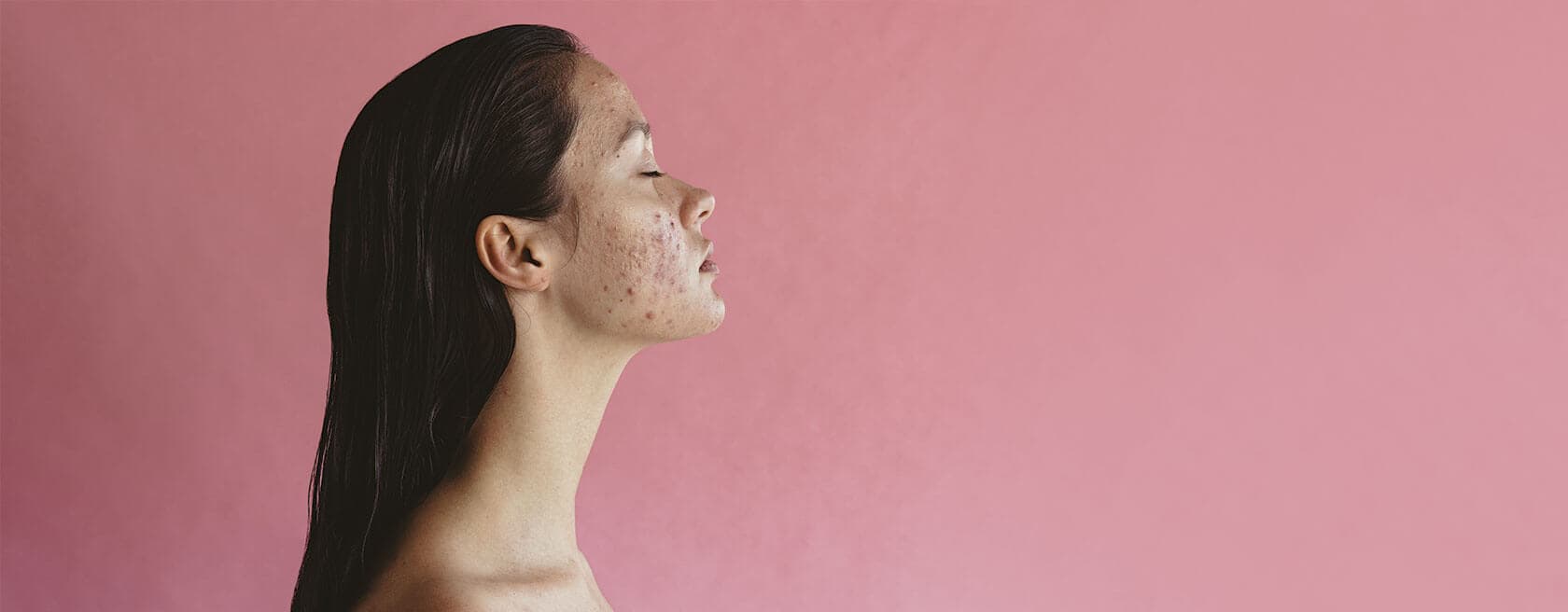 Skin Surgery Center Blog Hero - A Dermatologist's Guide to Treating Hormonal Acne