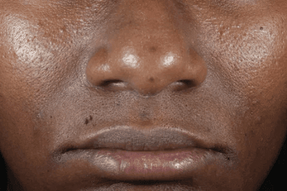 woman-porous-skin