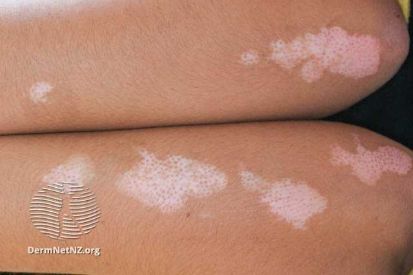 vitiligo-0010-WatermarkedWyJXYXRlcm1hcmtlZCJd