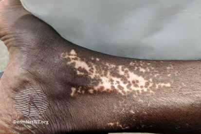 vitiligo-0012-WatermarkedWyJXYXRlcm1hcmtlZCJd